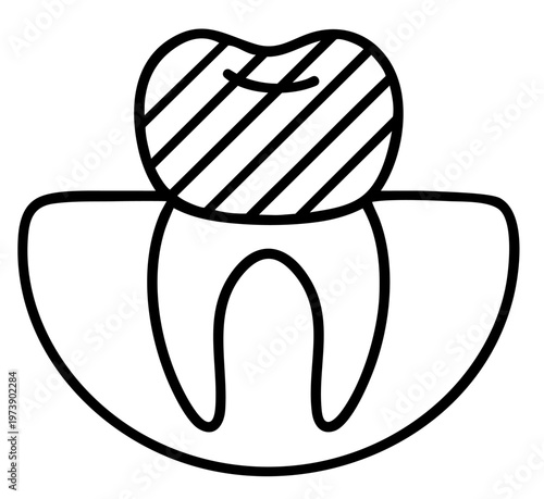 Dental Crown Covering Tooth, Prosthetic Restoration of Upper Tooth Structure