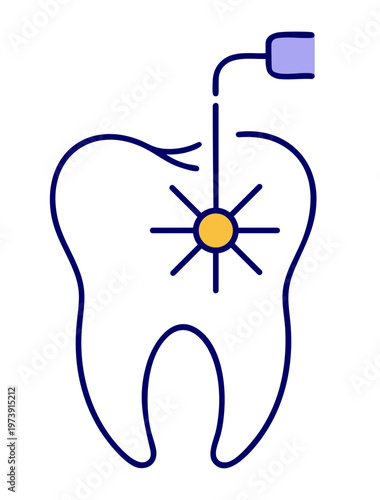 Laser Dental Treatment for Caries Removal and Root Canal Sterilization with Modern Painless Technology