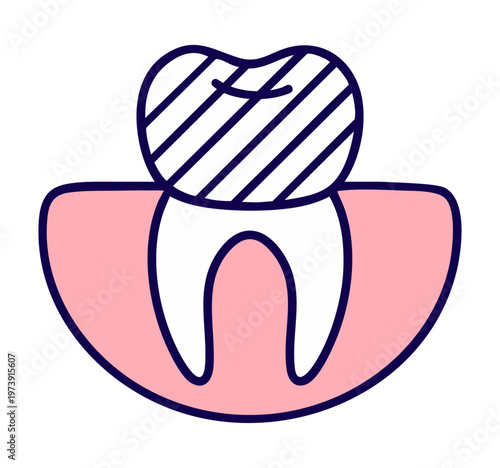 Tooth preparation for crown or veneer — enamel reduction and shaping for prosthetic restoration, dental procedure