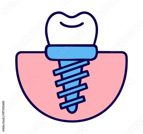 Dental implant with crown replacing missing root — titanium screw in jaw bone with artificial tooth restoration