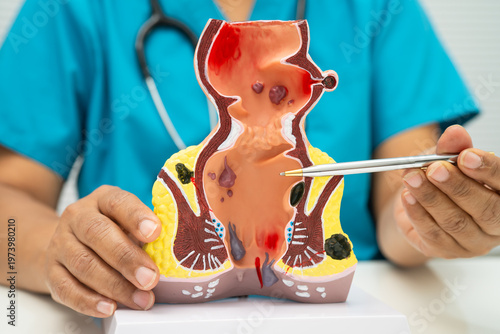 Asian doctor with rectum and hemorrhoid human anatomy model at hospital, inflamed vascular structure.