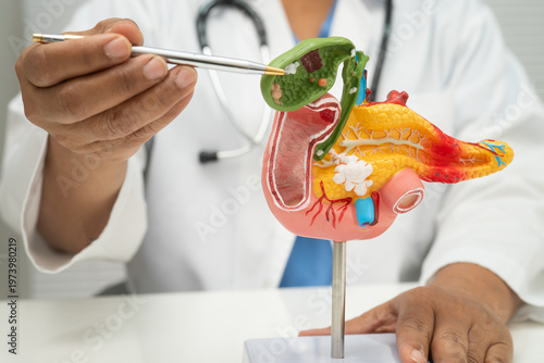 Fotografía Pancreatitis, pancreatic cancer, Asian doctor with pancreas, gallbladder and bile duct human anatomy model at hospital