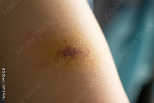 Bruise injury found on the female arm
