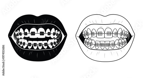 Two views of lips with dental braces black fill and white outline