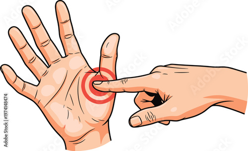 Illustration showing palm reflexology point being pressed for pain relief and wellness therapy goal.