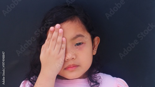 Asian girl's red and swollen eyes (conjunctivitis pink eye) on the left, with close view and black background.