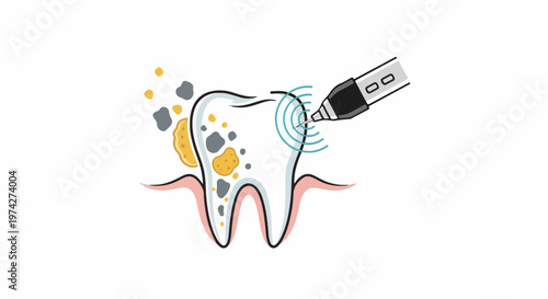 Illustration of a tooth being cleaned with a dental tool, showing buildup