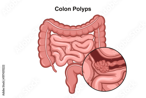 Illustration of human colon showing internal polyps with a magnified view of growths