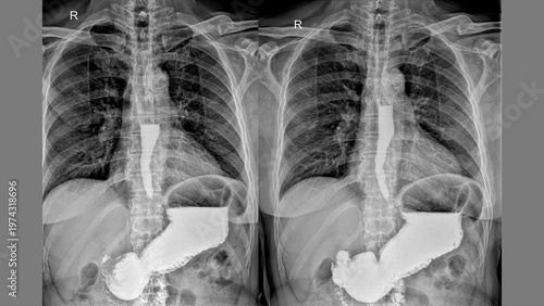 Photos Upper Torso X‑ray with Barium Contrast, AP Views
