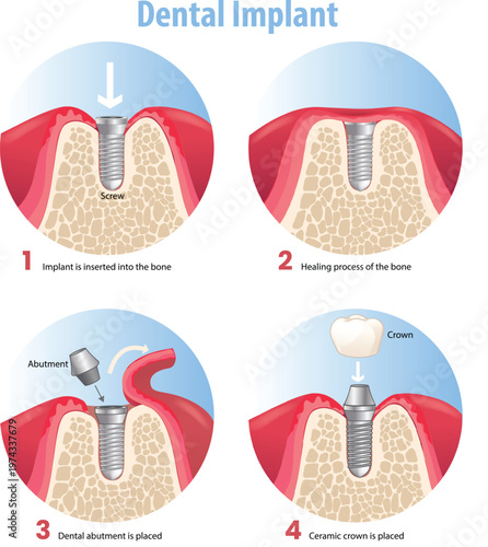 illustration of dental implant steps diagram