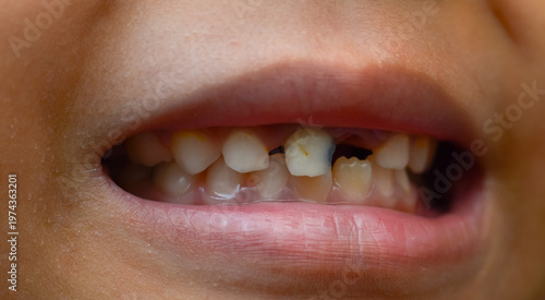 High Angle View of Child's Open Mouth Showing Cavities on Molars and Dental Plaque