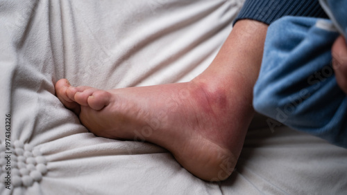 Billede på lærred Top view of injured foot with a cold compress on the bed