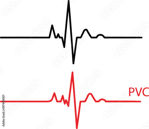 Heart rate monitor electrocardiogram showing normal sinus rhythm and premature ventricular contraction. Vector