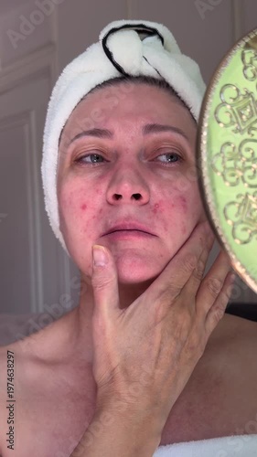 Upset middle aged woman with sensitive irritated skin applies hand to face looking in mirror, visible redness and uneven texture, frustration with appearance and daily skincare struggle