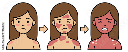 Cartoon illustration of skin disease progression depicting three stages of worsening rash and inflammation for medical and dermatology design