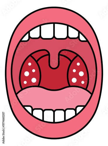 Cartoon illustration of an open mouth depicting inflamed tonsils with white spots for medical and healthcare design