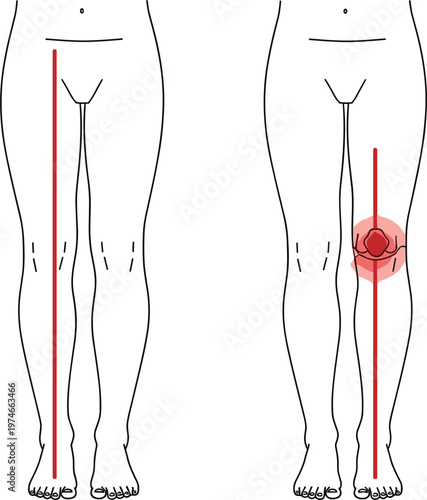 Human leg alignment diagram showing straight mechanical axis versus patella misalignment for orthopedic medical education clinical anatomy and physical therapy skeletal health illustrations.