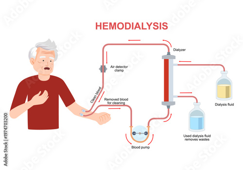 Hemodialysis for kidney treatment infographics. Man get a kidney disease treatment. Patient having a internal injection. Vector illustration in cartoon style
