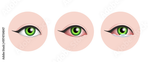Allergic conjunctivitis 3d illustration. Hand-drawn vector clip art.