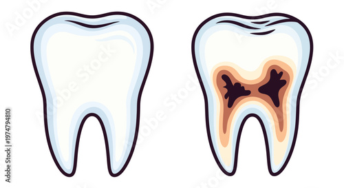 An illustration comparing a healthy tooth with a decayed tooth showing internal damage