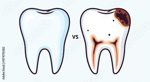 A healthy tooth compared to a decayed tooth with visible cavities and damage