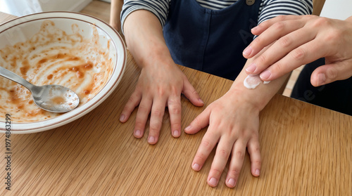 Child Hands With Red Rash From Food Allergy, , Mother Applying Cream,  Copy Space