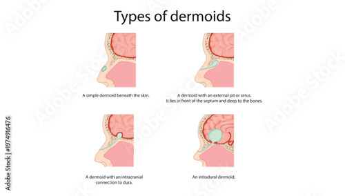 Type of dermoids
Diagram illustrating different types of dermoid cysts including simple dermoid, dermoid with sinus tract, intracranial connection, and intradural dermoid.