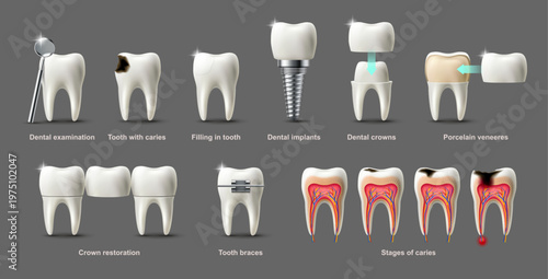 Dental tools and procedures including crowns implants caries restoration and examination