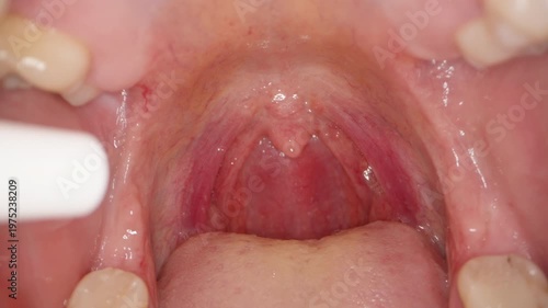 Spray Being Applied into Sore Throat with Redness and Visible Veins on Soft Palate and Uvula, Extreme Macro Close-Up, Medical Treatment Concept