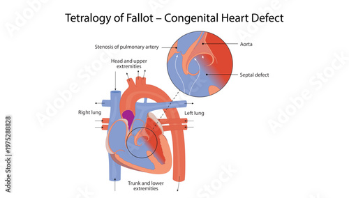 Tetralogy of Fallot – Congenital Heart Defect
Tetralogy of Fallot with pulmonary stenosis, ventricular septal defect, overriding aorta, and right ventricular hypertrophy.
