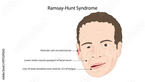 Ramsay Hunt Syndrome (Herpes Zoster Oticus)
facial nerve paralysis, ear vesicular rash, and loss of taste associated with Ramsay Hunt syndrome.