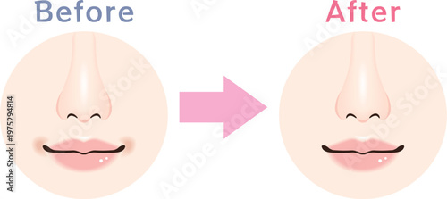 口周りのくすみ Before After