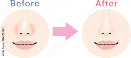 小鼻の赤み ビフォーアフター 比較イラスト