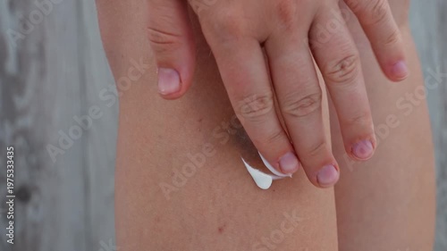 Unrecognized person rubbing recovery healing cream bruises on body at home scene. Close-up of woman with bruised leg. Bruising leg area, injury accident. Concept of home abuse. Consequences of