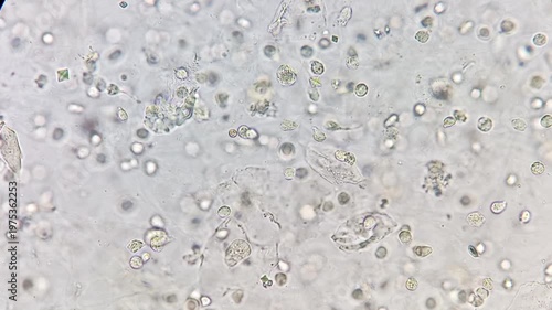 Footage of Calcium oxalate monohydrate, pus cells in urine under microscope.