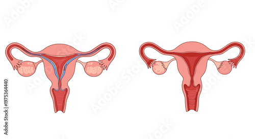 Medical illustration showing a comparison of a healthy human uterus and ovaries with one showing abnormal changes or conditions on white.