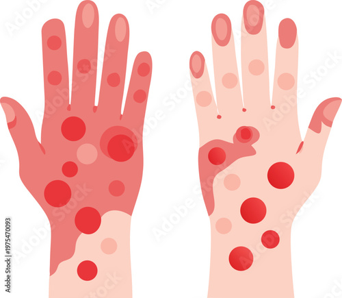 Illustration depicting hands with a noticeable skin rash and spots