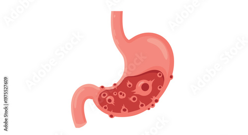 Internal view of a human stomach showing various bacteria or germs causing an infection within the digestive system organ.