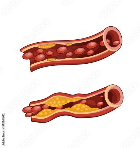 Blocked Artery with Severe Cholesterol Plaque and Healthy Artery with Blood Flow Illustration