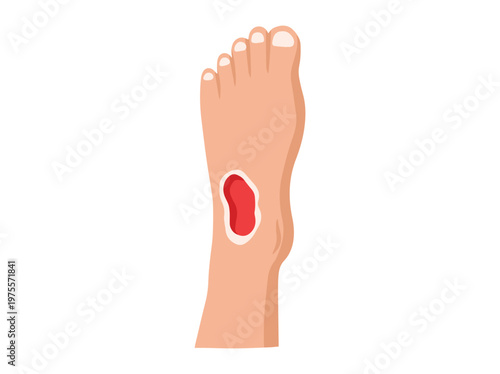 Diabetic Foot Ulcers Cartoon Illustration