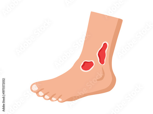 Diabetic Foot Ulcers