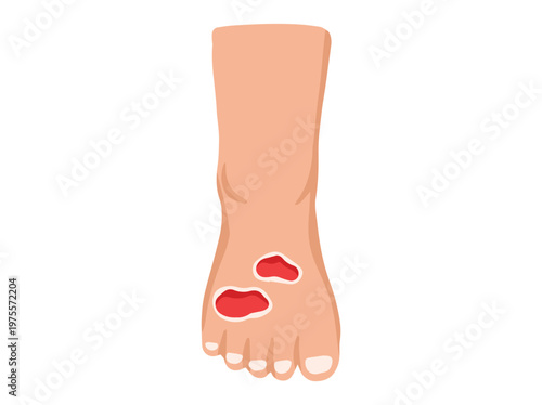 Diabetic Foot Ulcers Cartoon Illustration