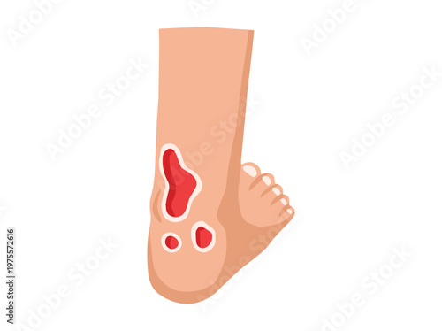 Hand Drawn Diabetic Foot Ulcers