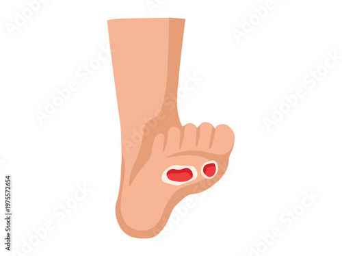 Diabetic Foot Ulcers Cartoon Illustration