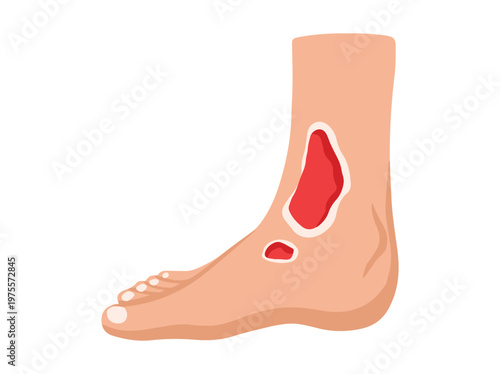Diabetic Foot Ulcers Cartoon Illustration