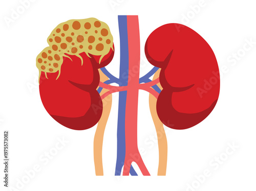 Human Kidney Cancer Disease Illustration