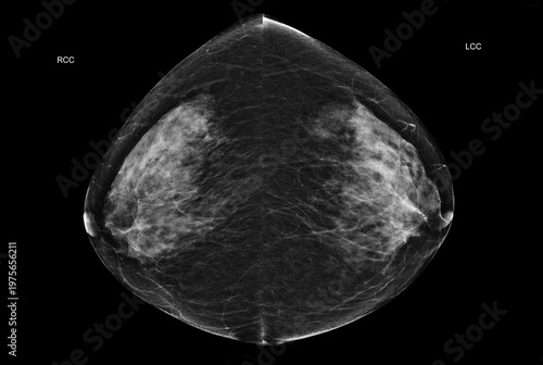 Bilateral craniocaudal (CC) view  mammogram of healthy breasts showing benign tissue (BI-RADS 2).