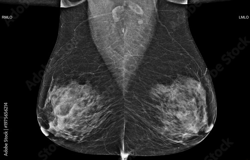 Bilateral mediolateral oblique (MLO) mammogram of healthy breasts showing benign tissue (BI-RADS 2) .