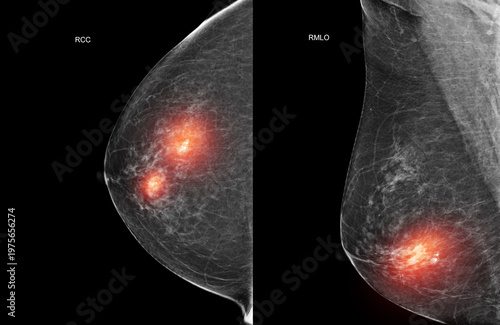 Bilateral mammogram x-ray displaying benign calcifications in both breasts with red highlight. Medical concept for women's health screening, routine checkup, and non-cancerous breast conditions.