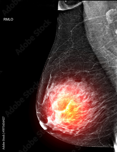 Right MLO view mammogram with a red glowing effect highlighting a potential breast tumor, cancer.